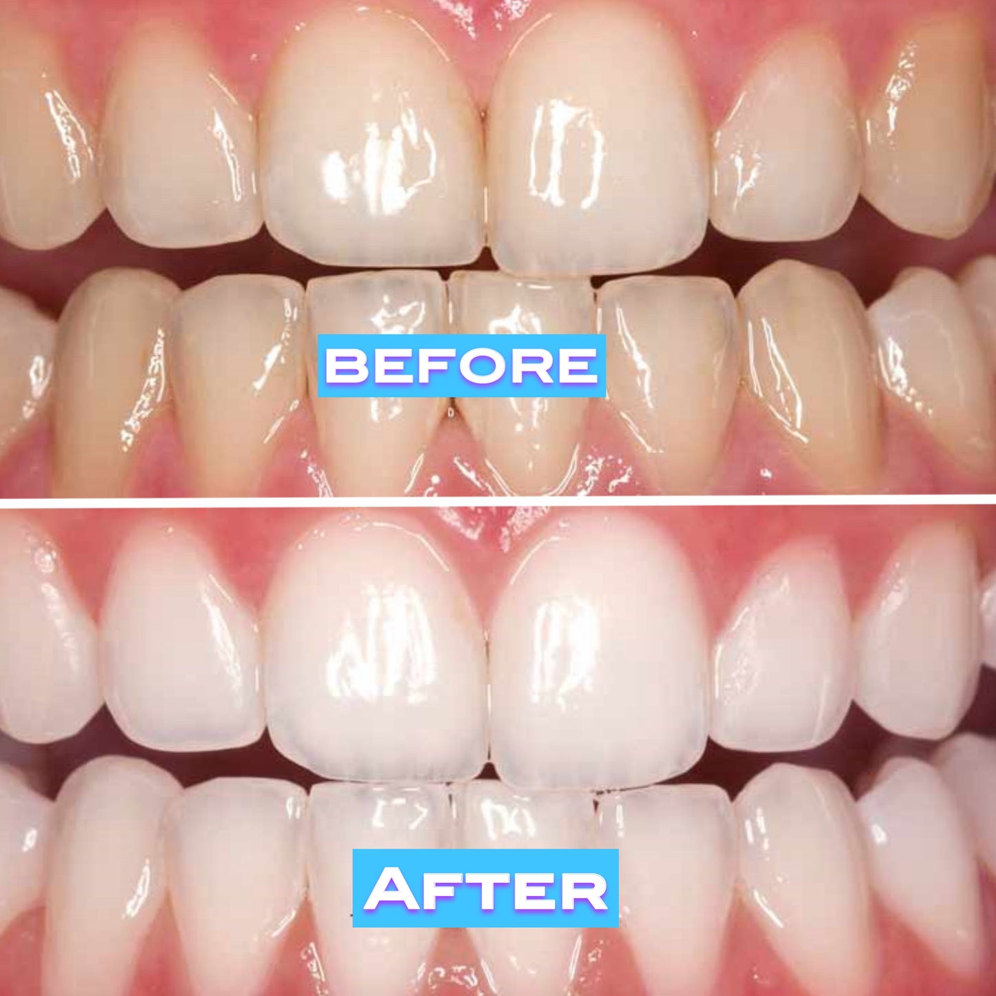 Teeth Power Washing Water Jet